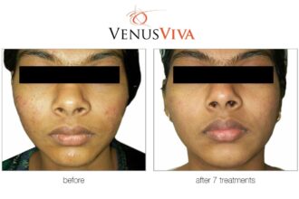 Nano-Fractional Resurfacing at First Ave Medical Spa