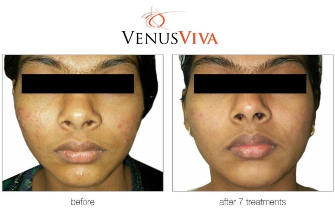 Nano-Fractional Resurfacing at First Ave Medical Spa
