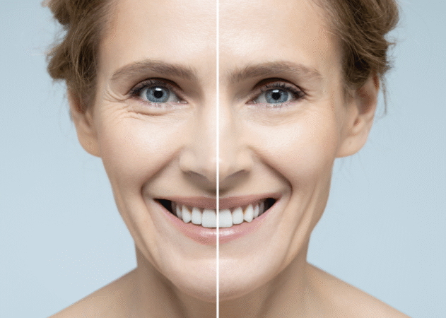 Skin Tightening