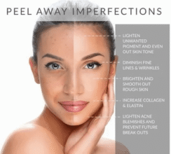 Chemical Peels Vancover