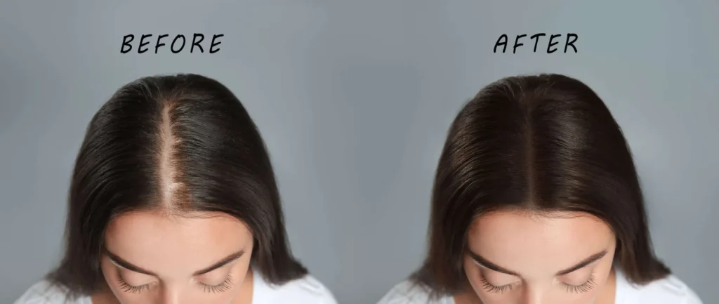 PRP Hair Treatment Vancouver