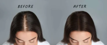PRP Hair Treatment Vancouver