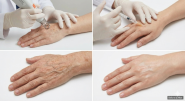 Hand Rejuvenation First Ave Medical Spa