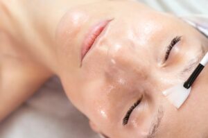 Chemical Peel at First Ave Medical Spa In Vancouver