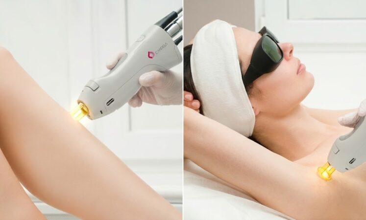 First Laser Hair Removal Session in Kitsilano
