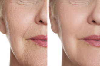 Morpheus8 in Vancouver