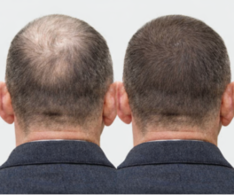 PRP Hair Restoration Vancouver