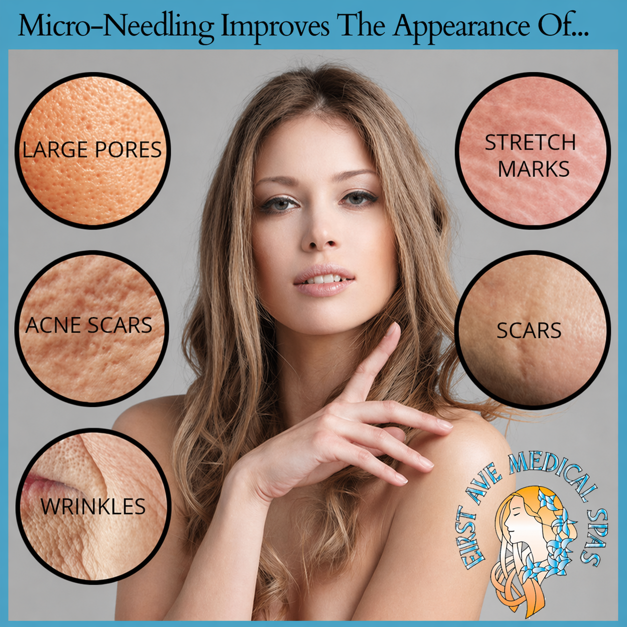 Benefits of Microneedling Treatment