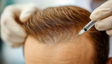 PRP sessions hair loss Vancouver