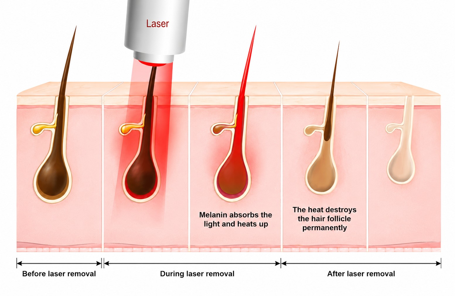 How Laser Hair Removal Works Step by Step