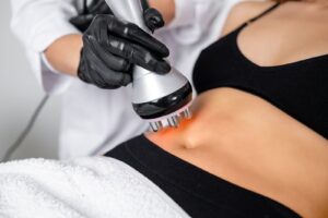 Morpheus8 body treatment on the abdomen at First Avenue Medical Spa in Kitsilano, Vancouver