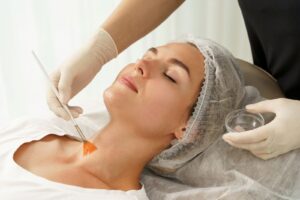 chemical-peel-for-pigmentation-vancouver first ave medical spa